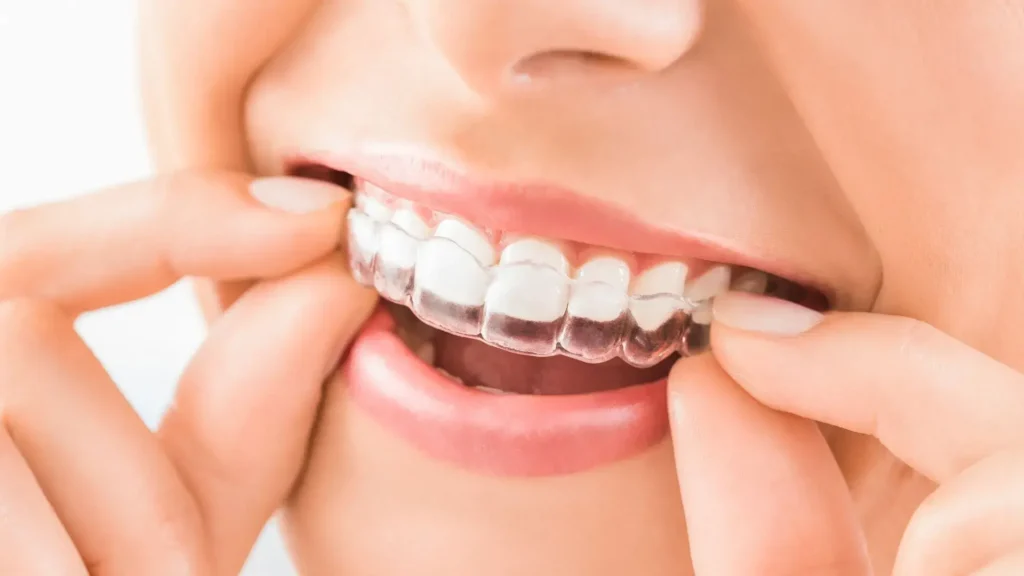 Leland Invisalign